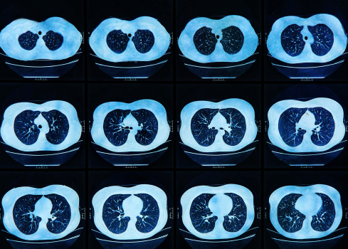A breath test for cancer?