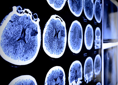 Can changes in behavior predict Alzheimer’s?
