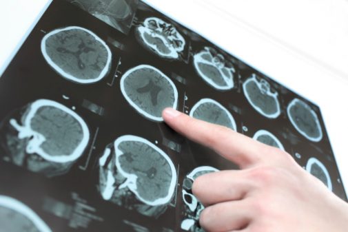Can this activity fight back against Parkinson’s?