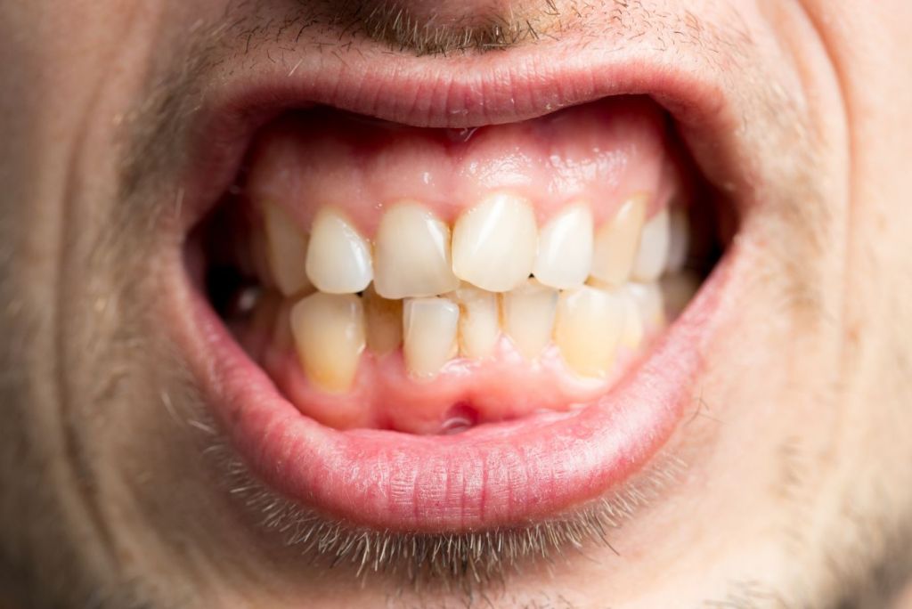 Can Crooked Teeth Cause Jaw Problems