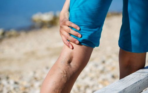Finding relief from varicose veins