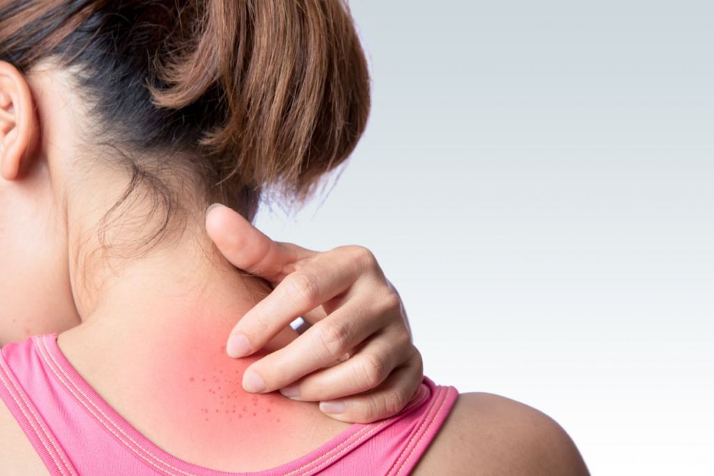 this-skin-irritation-is-common-in-hot-weather-health-enews